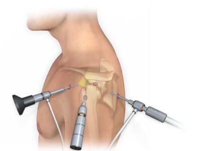 Total Joint Replacement Surgery