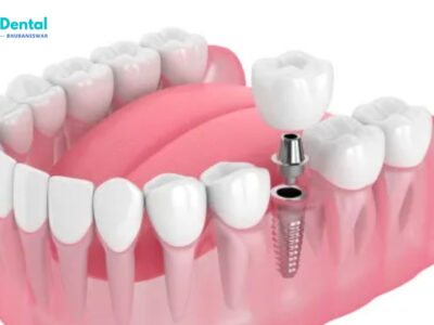 Discover the Best Dental Implants in Patia