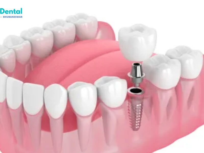 Discover the Best Dental Implants in Patia