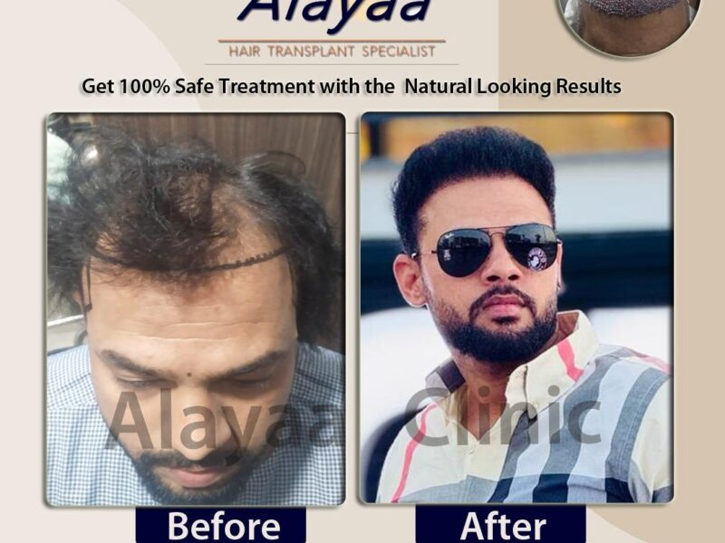 Chandigarh's Leading Hair Transplant Clinic in Chandigarh Affordable Solution