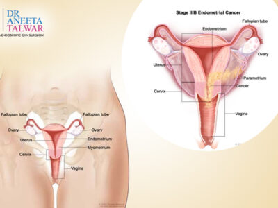 Best Endometrial Cancer Treatment in Manipal