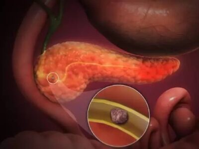 Pancreatic Stone Treatment in Chennai