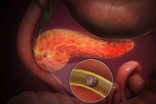 Pancreatic Stone Treatment in Chennai