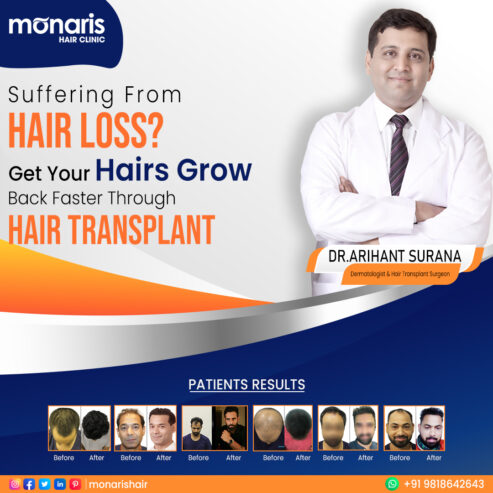 Discover the Best Hair Transplant in Delhi