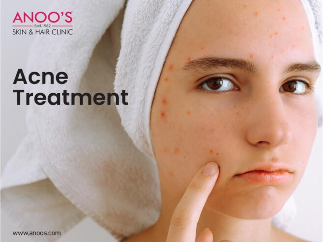 Advanced Acne Removal Treatment at Anoos