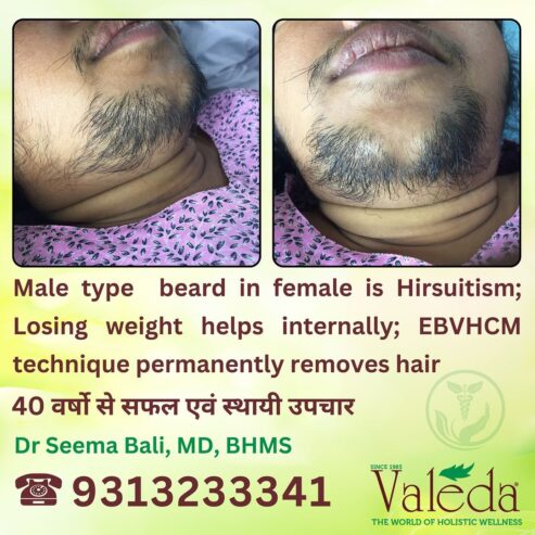 Permanent Hair Removal by VALEDA – EBVHCM – 40 Years O