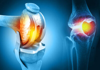 joint-replacement