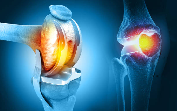 Best joint replacement surgeon in Hyderabad