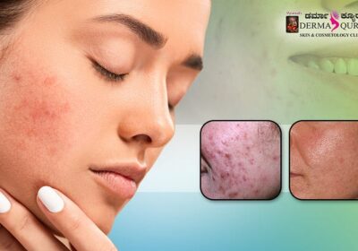 Deep-Acne-Scar-Treatments-in-Bangalore