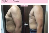 Best Gynecomastia Surgery in Ludhiana