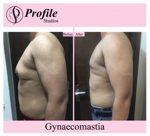 gynaecomastia-1-300×272-1