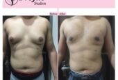 Best Gynecomastia Surgery in Ludhiana