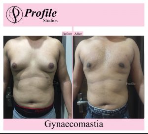 Best Gynecomastia Surgery in Ludhiana