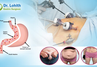 weight-loss-surgery-in-bangalore-1