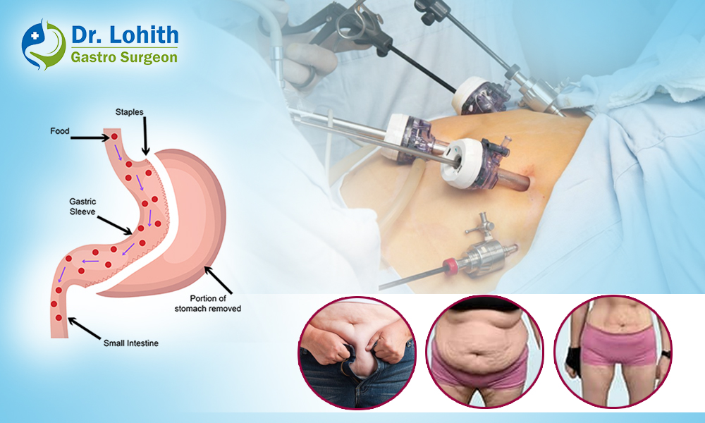 Best Bariatric & Weight Loss Surgery in Bangalore
