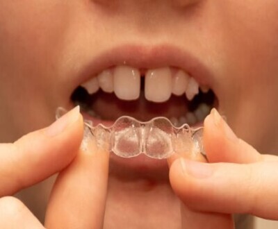 Orthodotic Dental Treatment for Misaligned Teeth In In