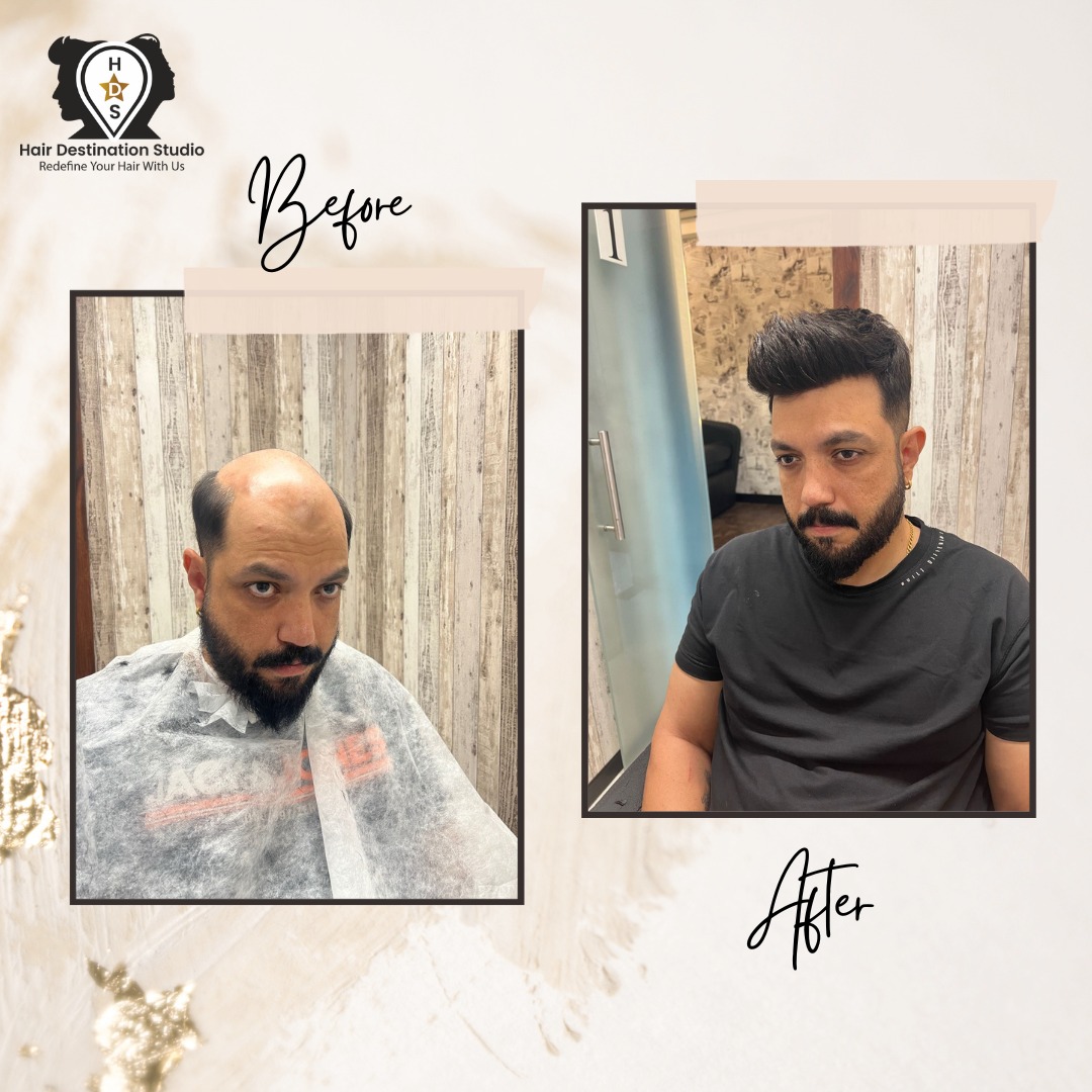 Best Hair Patch Service in Mumbai