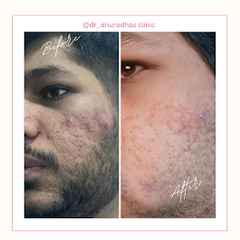 Top Skin & Homeopathy Clinic in Balewadi – Dr. Anuradh