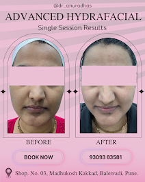 Top Skin & Homeopathy Clinic in Balewadi – Dr. Anuradh