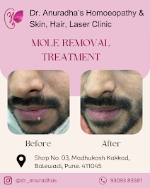Top Skin & Homeopathy Clinic in Balewadi – Dr. Anuradh