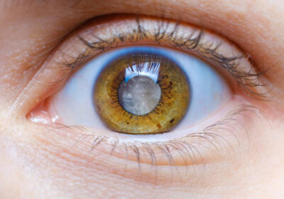glaucoma-treatment-1