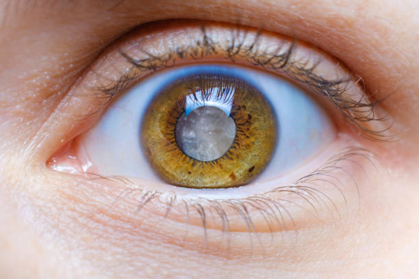 Best Clinic for Glaucoma Treatment in Mumbai