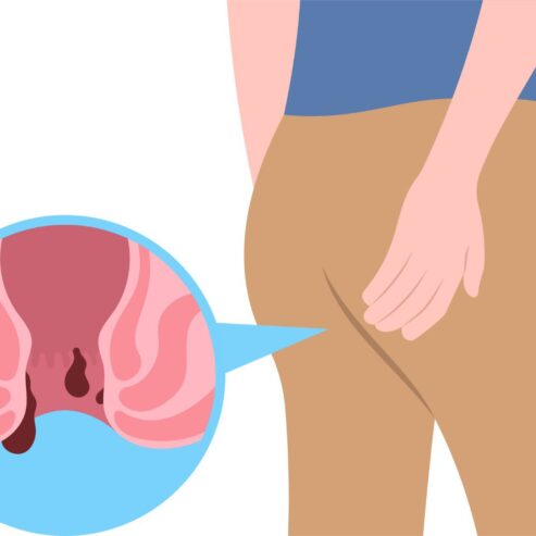 Piles Treatment in Bangalore