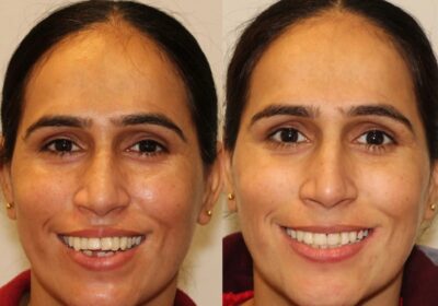 Dr.-Ankur-Mohindru-Best-dentist-in-amritsars-2