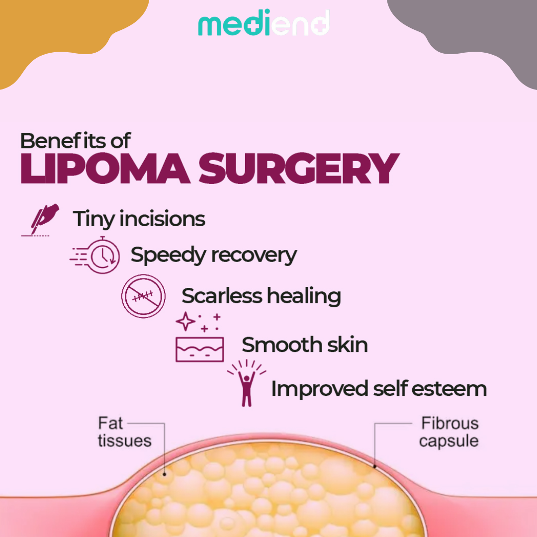 Lipoma Removal Treatment in Delhi NCR | mediEND