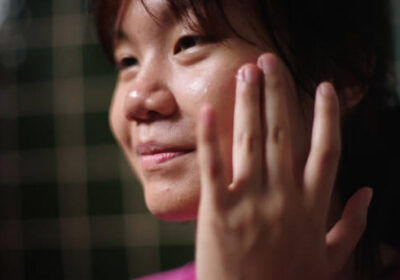 Acne-Treatment-in-Riyadh-13