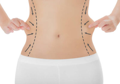 Lipo-Abdominoplasty-in-Riyadh-6