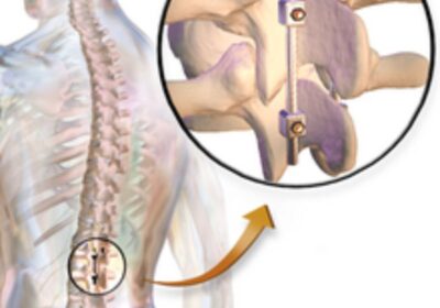 Spinal-Fusion-Surgery