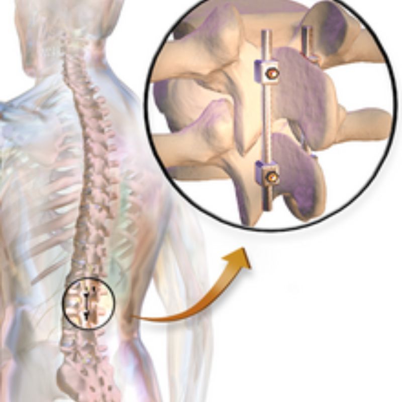 Affordable Cost of Spinal Fusion Surgery India