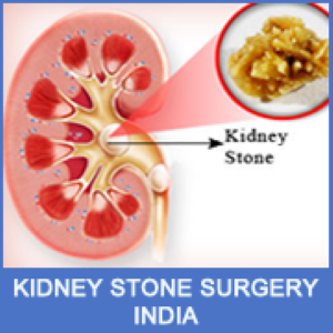 Best Urethroplasty Specialist in India