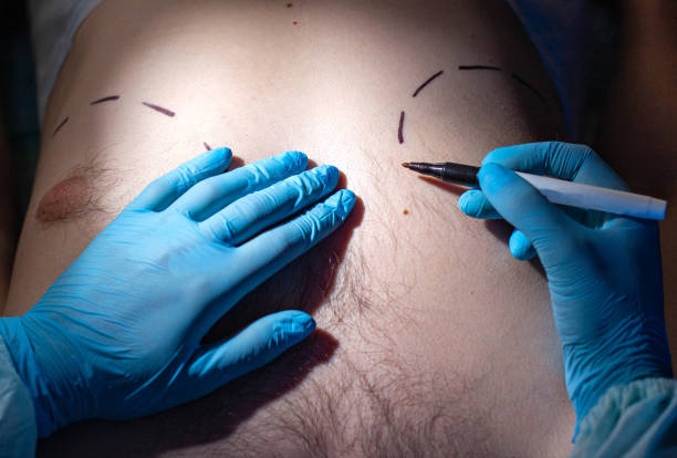 Gynecomastia Surgery in Riyadh