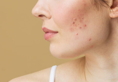 Acne-Scar-Treatment-in-Riyadh-13
