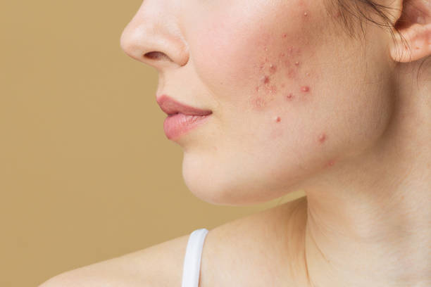 Acne Scar Treatment in Riyadh