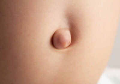 Cost-of-hernia-surgery-in-Riyadh-8