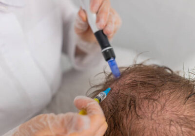Exosomes-Therapy-for-Hair-Loss-in-Riyadh-7