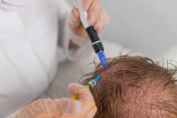 Exosomes Therapy for Hair Loss in Riyadh