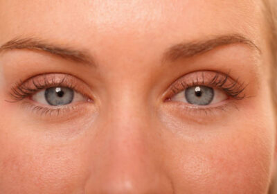 Eyelid-Lift-in-Riyadh-6