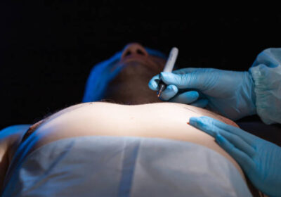 Gynecomastia-Surgery-in-Riyadh-5