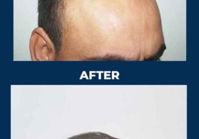 Hair-Transplant-07-12-2024-1-1-1-1