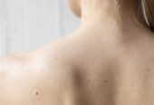 How to Treat Back Acne and Its Effects?