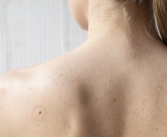 How-to-Treat-Back-Acne-and-Its-Effects-7