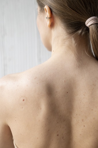 How to Treat Back Acne and Its Effects?