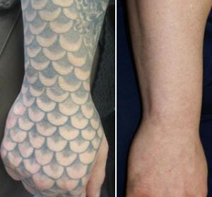 Laser-Tattoo-Removal-15
