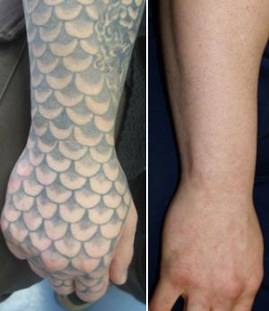 Laser Tattoo Removal