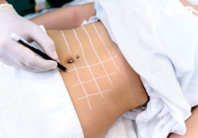 Liposuction-Cost-in-Riyadh-4