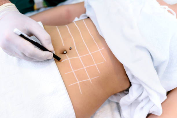 Liposuction Cost in Riyadh